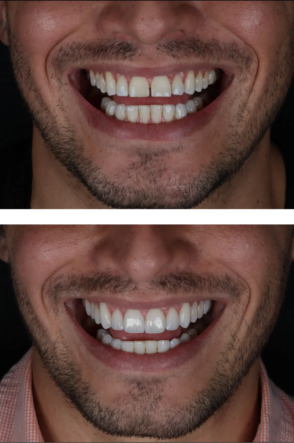 Planejamento de clareamento dental na Bass Odontologia, na Saúde em São Paulo
