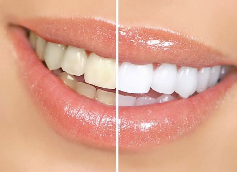 Avaliação estética para facetas dentárias na Bass Odontologia em São Paulo