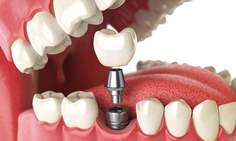Planejamento de prótese dentária na Bass Odontologia na Vila da Saúde